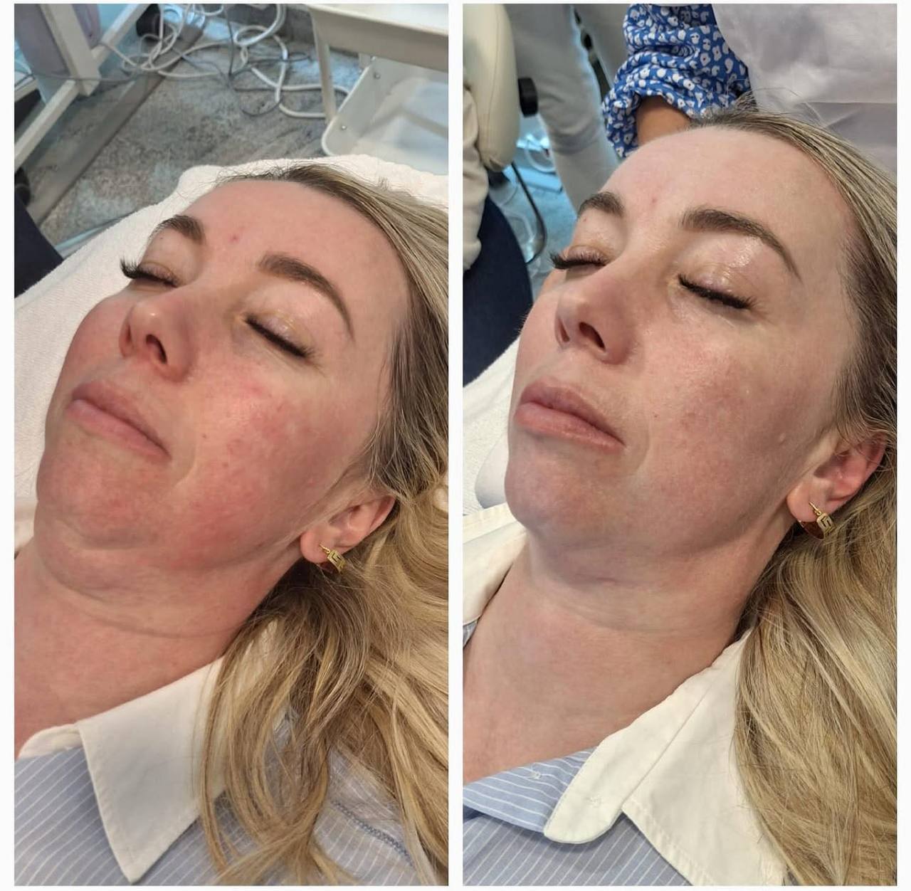 Couperose und Rosazea